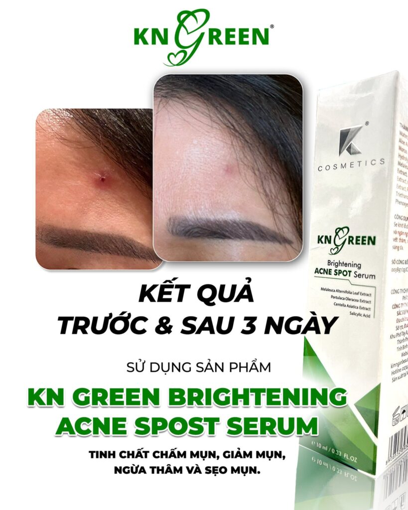 Giảm viêm khô cồi mụn sau 3 ngày acne spot serum
